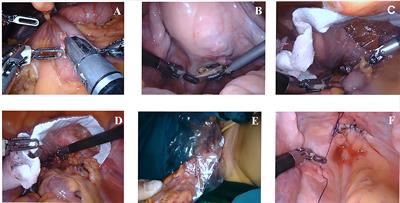 Transvaginal versus transabdominal specimen extraction surgery for right colon cancer: A propensity matching study